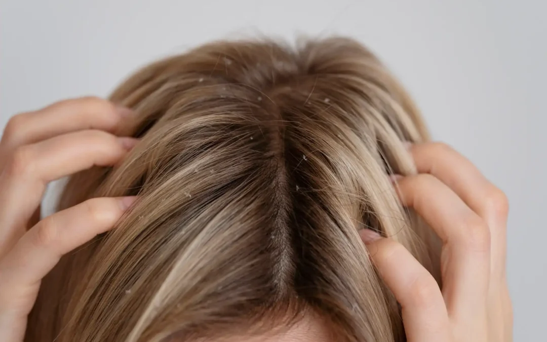 Dandruff – most people that say they have dandruff actually don’t!